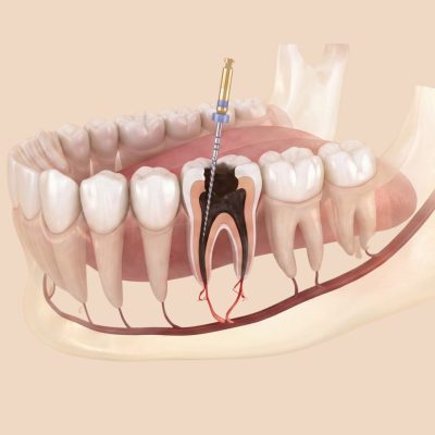 Điều Trị Răng, Tuỷ